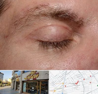 جراح بلفاروپلاستی در عطاران قم