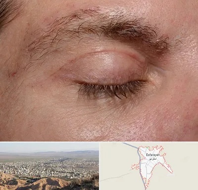 جراح بلفاروپلاستی در اسفراین