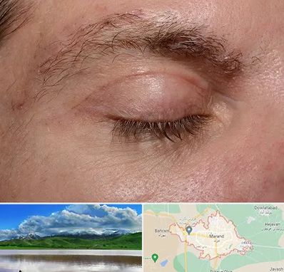 جراح بلفاروپلاستی در مرند