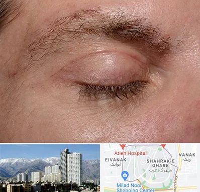 جراح بلفاروپلاستی در شهرک غرب 