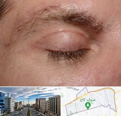 جراح بلفاروپلاستی در سعادت آباد 