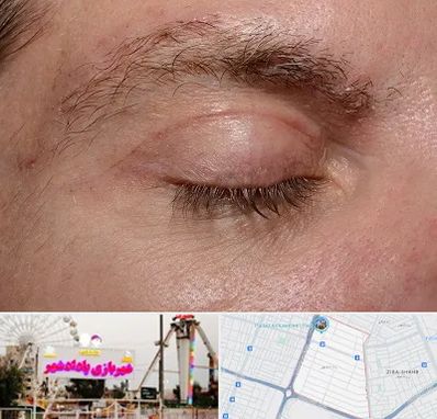 جراح بلفاروپلاستی در پادادشهر اهواز