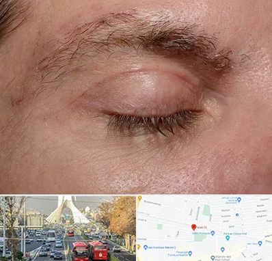 جراح بلفاروپلاستی در خیابان آزادی 