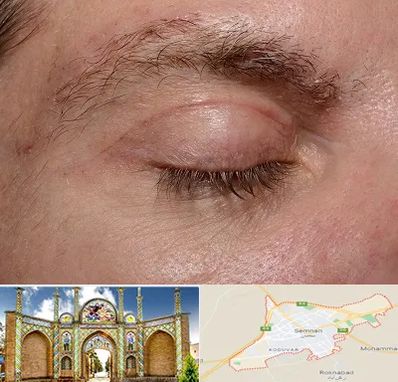 جراح بلفاروپلاستی در سمنان