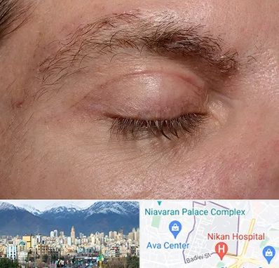 جراح بلفاروپلاستی در آجودانیه 