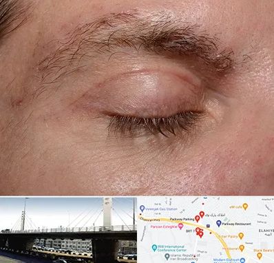 جراح بلفاروپلاستی در پارک وی 