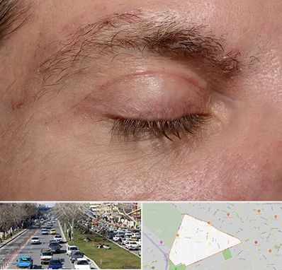 جراح بلفاروپلاستی در احمدآباد مشهد 