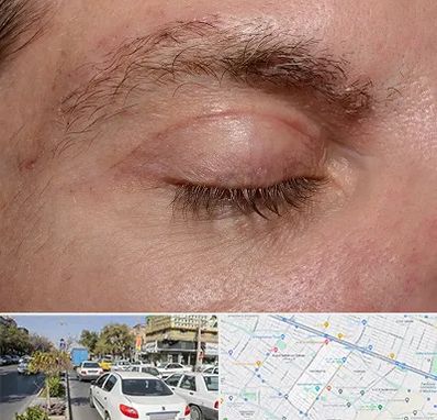 جراح بلفاروپلاستی در مفتح مشهد