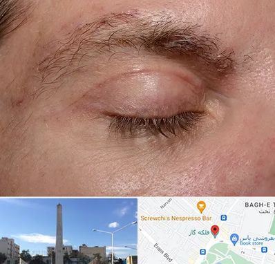 جراح بلفاروپلاستی در فلکه گاز شیراز