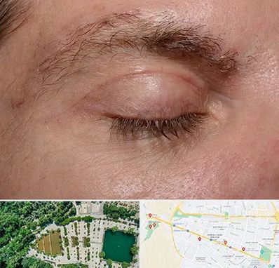 جراح بلفاروپلاستی در وکیل آباد مشهد 