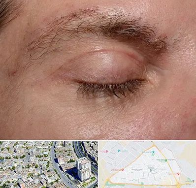 جراح بلفاروپلاستی در قاسم آباد مشهد 