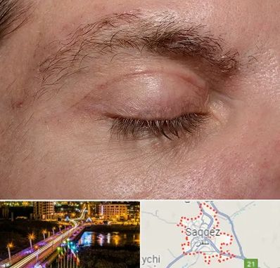 جراح بلفاروپلاستی در سقز