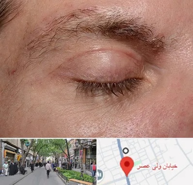 جراح بلفاروپلاستی در ولیعصر شهریار