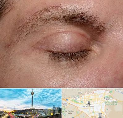 جراح بلفاروپلاستی در تهران