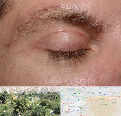 جراح بلفاروپلاستی در منطقه 13 تهران 