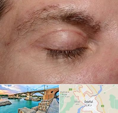 جراح بلفاروپلاستی در دزفول