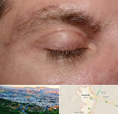 جراح بلفاروپلاستی در سنندج