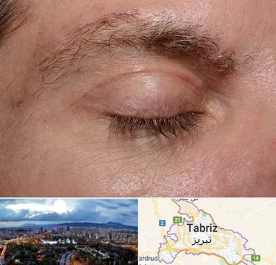 جراح بلفاروپلاستی در تبریز