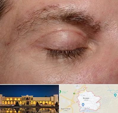 جراح بلفاروپلاستی در برازجان