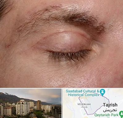 جراح بلفاروپلاستی در زعفرانیه 