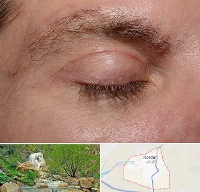 جراح بلفاروپلاستی در کردان