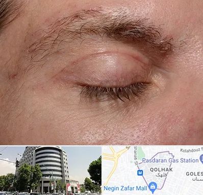 جراح بلفاروپلاستی در قلهک 
