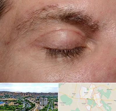 جراح بلفاروپلاستی در شهریار