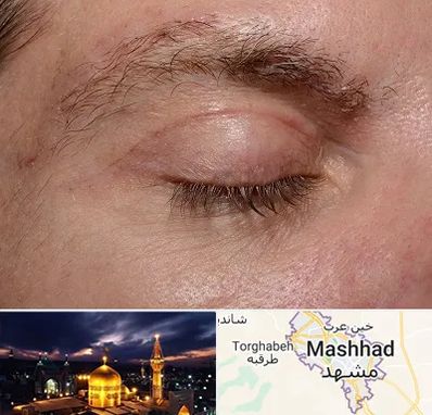 جراح بلفاروپلاستی در مشهد