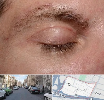 جراح بلفاروپلاستی در مجیدیه شمالی