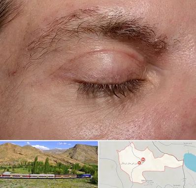 جراح بلفاروپلاستی در خاش