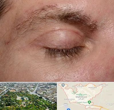 جراح بلفاروپلاستی در شهرکرد