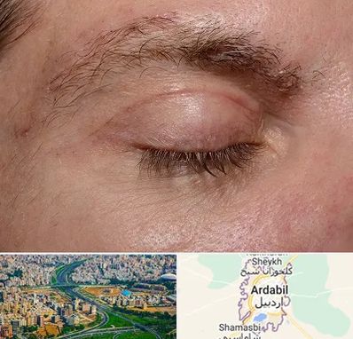 جراح بلفاروپلاستی در اردبیل