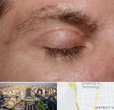 جراح بلفاروپلاستی در استاد معین 