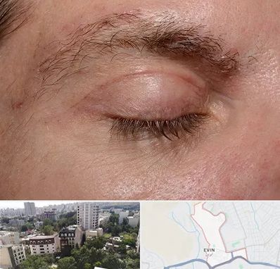 جراح بلفاروپلاستی در اوین