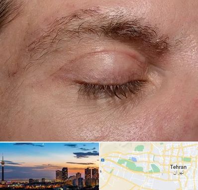 جراح بلفاروپلاستی در غرب تهران 