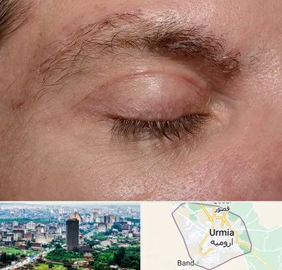 جراح بلفاروپلاستی در ارومیه