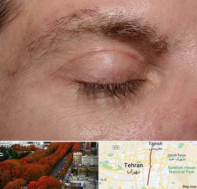 جراح بلفاروپلاستی در ولیعصر 