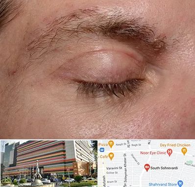 جراح بلفاروپلاستی در سهروردی 