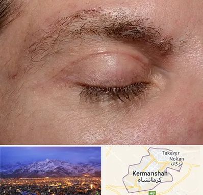 جراح بلفاروپلاستی در کرمانشاه