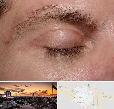 جراح بلفاروپلاستی در قوچان