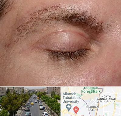 جراح بلفاروپلاستی در شهران 