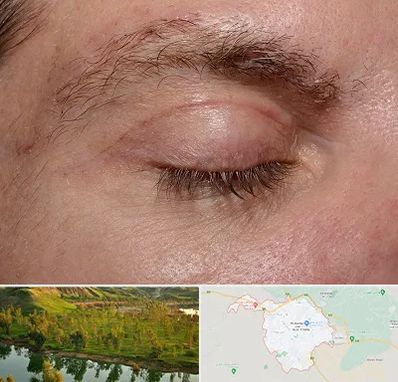 جراح بلفاروپلاستی در بهبهان