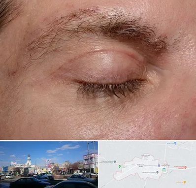 جراح بلفاروپلاستی در ماهدشت کرج 