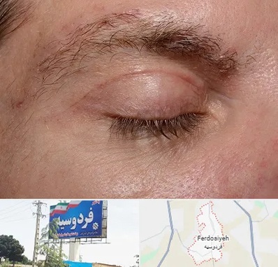 جراح بلفاروپلاستی در فردوسیه شهریار