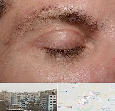 جراح بلفاروپلاستی در محمد شهر کرج 