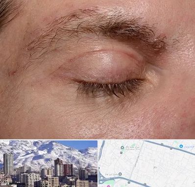 جراح بلفاروپلاستی در ازگل