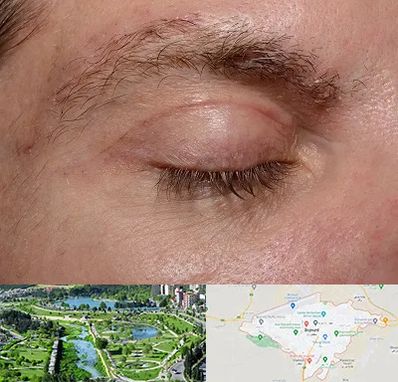 جراح بلفاروپلاستی در بجنورد