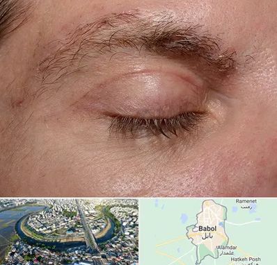 جراح بلفاروپلاستی در بابل