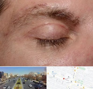 جراح بلفاروپلاستی در بلوار معلم مشهد 