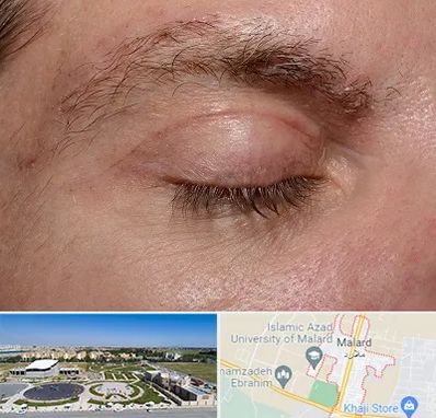 جراح بلفاروپلاستی در ملارد